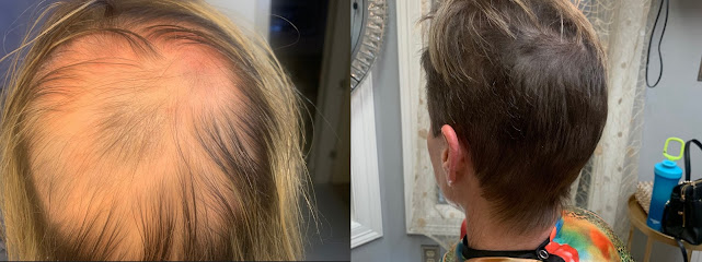 Arizona Aesthetics | Hair Restoration & Stem Cell Therapy