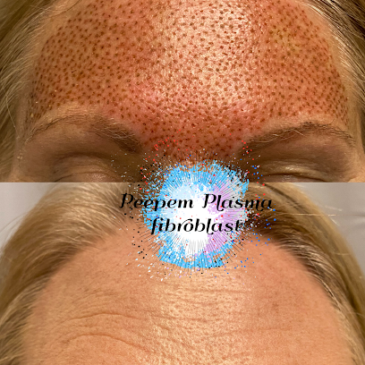 Peepem Plasma Fibroblast Peepem Plasma Fibroblast